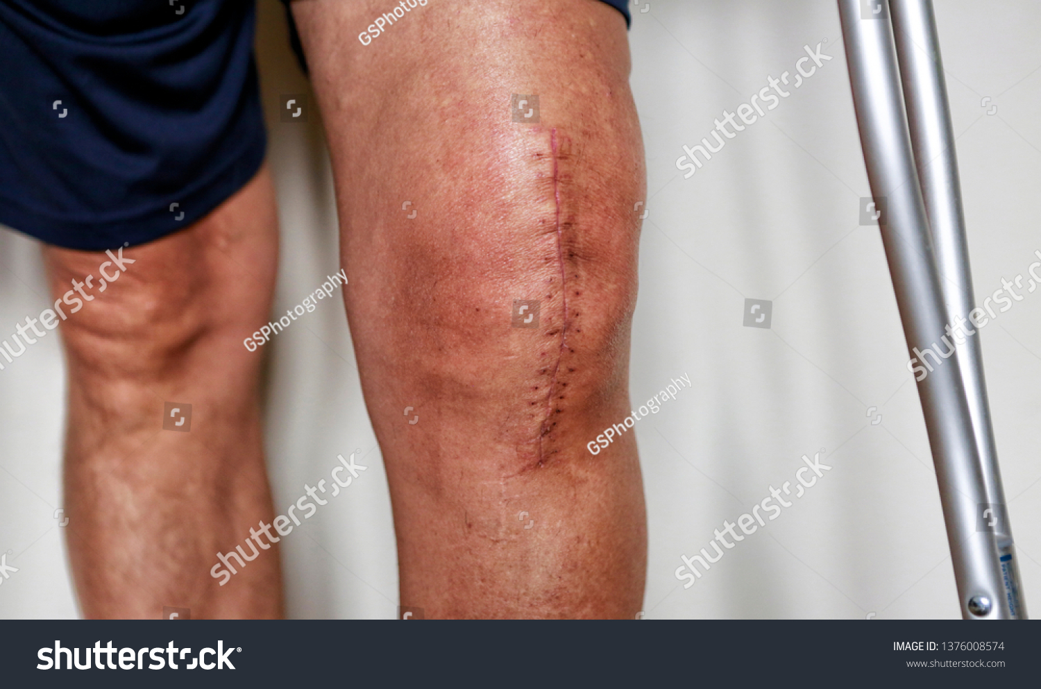 How To Rehab A Bone Bruise Knee